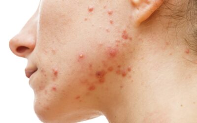 Man Secretly Feeds Vegan Girlfriend Dairy to Check If It Will Cause Acne